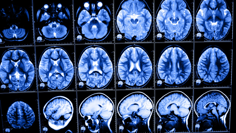 Afbeelding neurochirurgie
