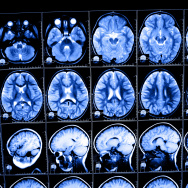 Afbeelding neurochirurgie